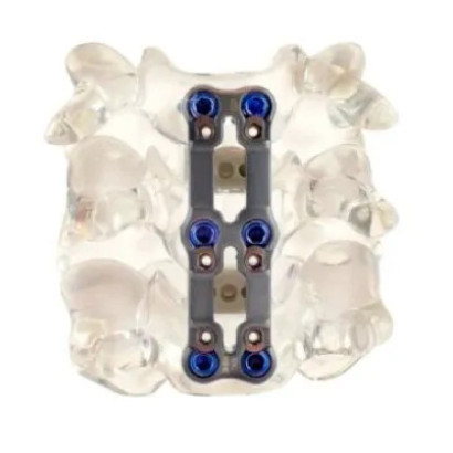 Cervical Plate