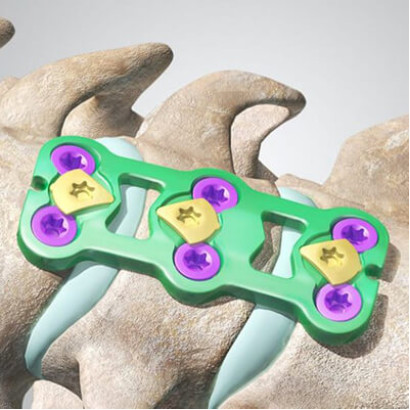 Cetra Anterior Cervical Plate (ACP) System