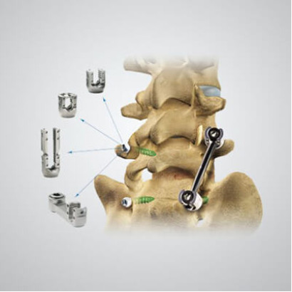 Firebird Spinal Fixation System