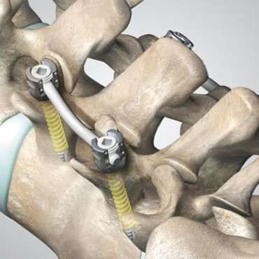 Firebird NXG Spinal Fixation System