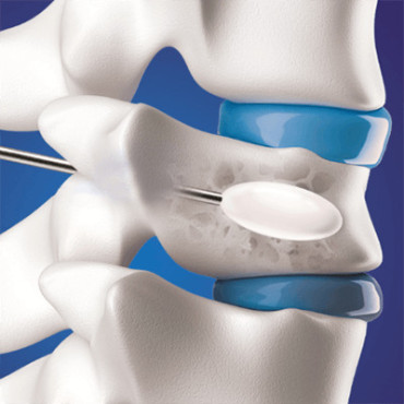 Tracker™ System for Kyphoplasty