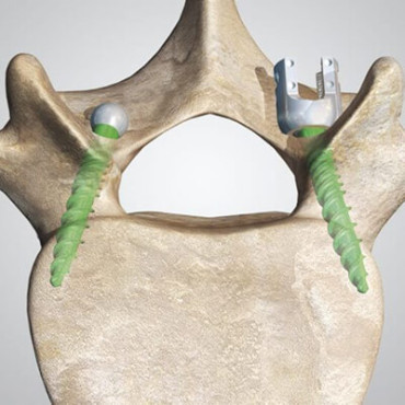 JANUS Midline Fixation Screw