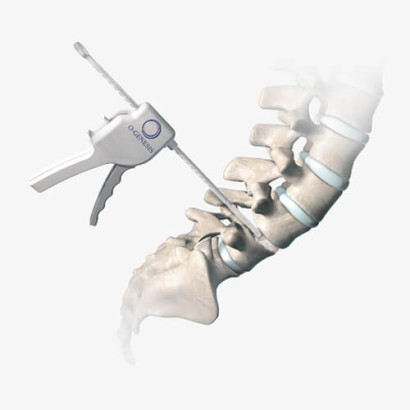 O-Genesis Graft Delivery System