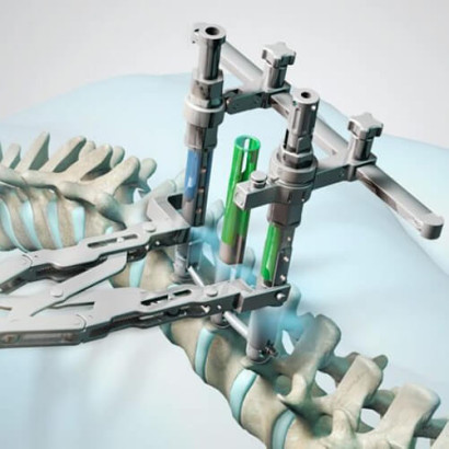 Phoenix CDX Minimally Invasive Spinal Fixation System